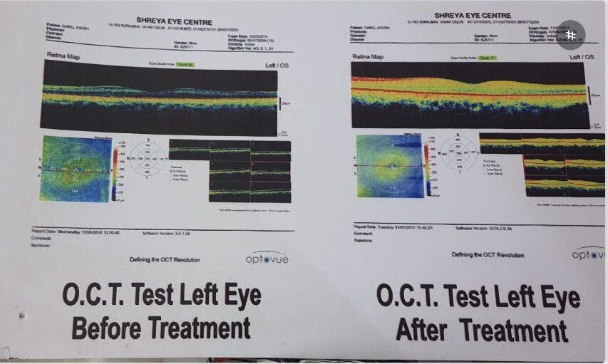 Treatment of Macular Degeneration